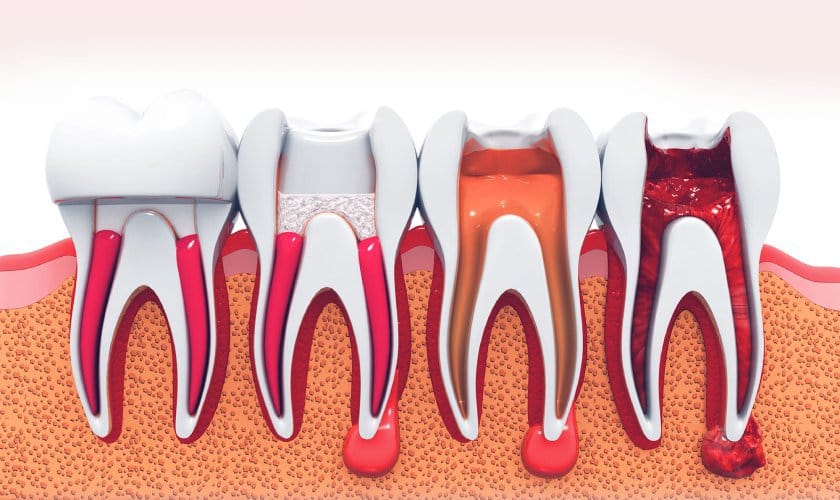 root canal treatment