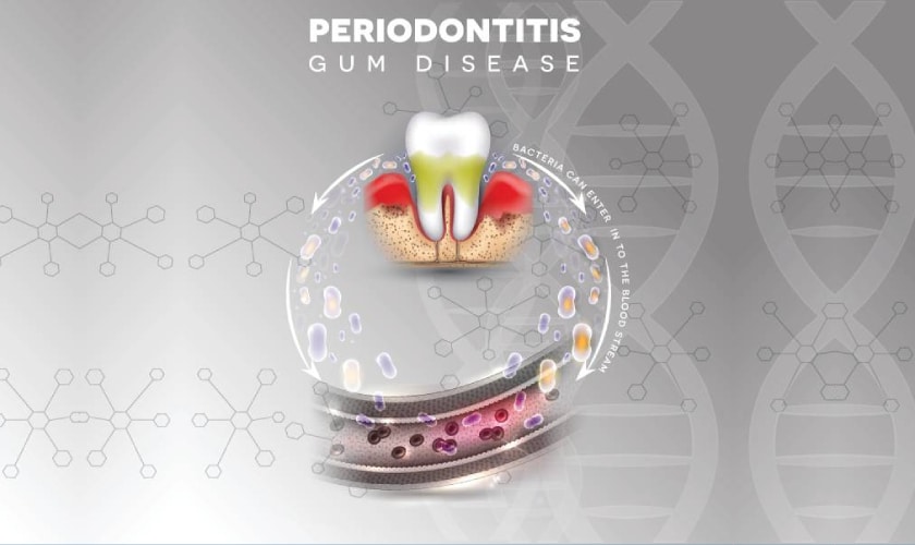What You Should Know About Periodontitis And Its Treatment?