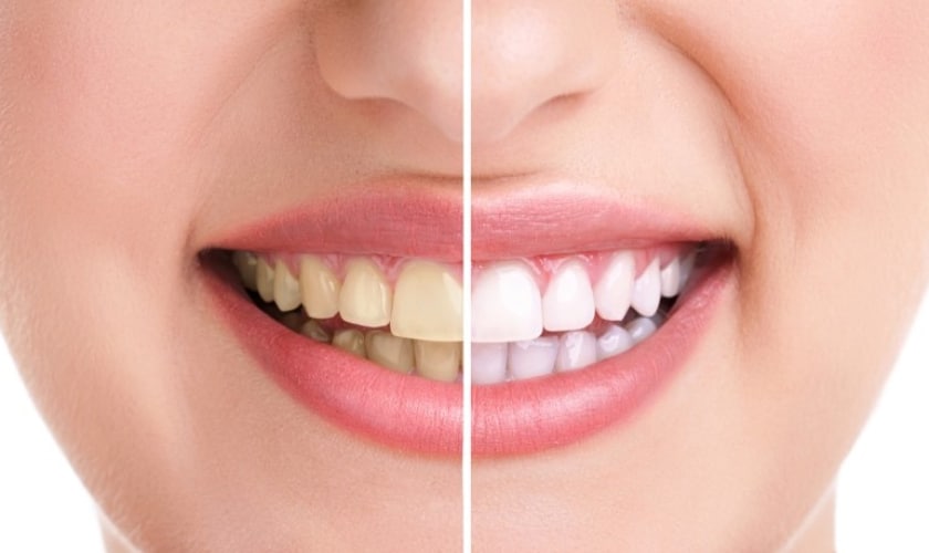 Teeth Whitening in McKinney - Dentist in McKinney - Custer Creek Dental Care