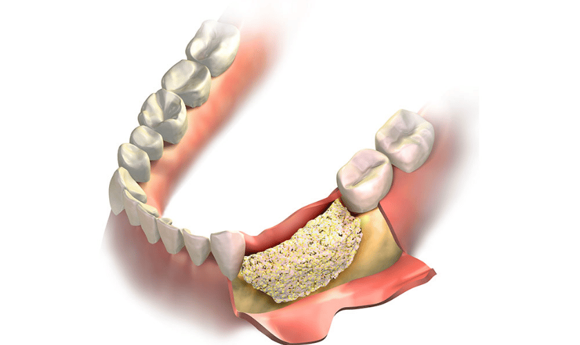bone grafting