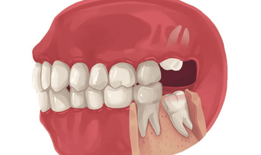 wisdom tooth extraction