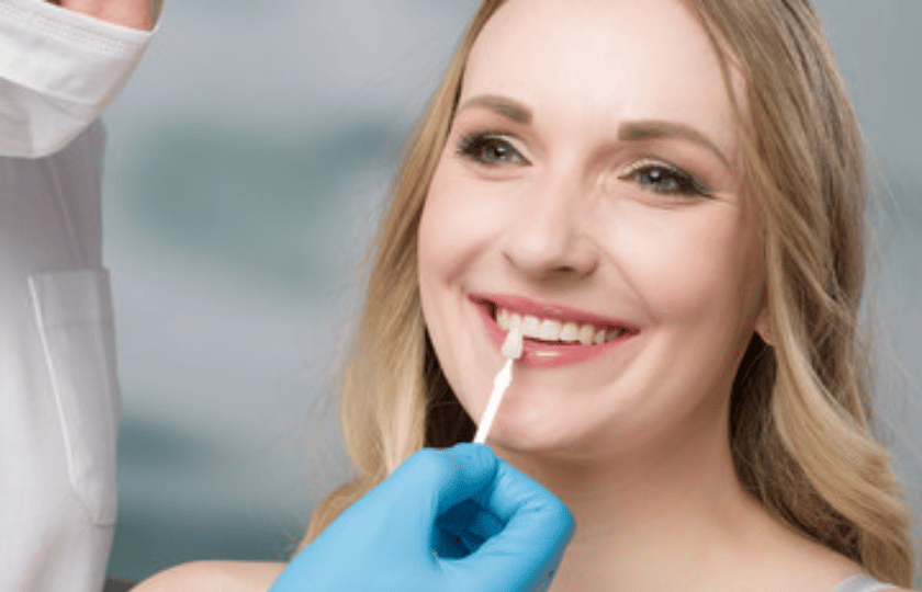 dental veneers