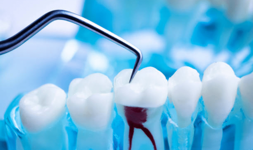 What Do You Need to Learn Before Your Root Canal Treatment?