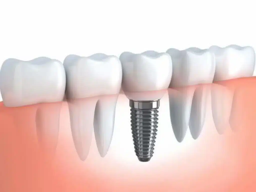 Tooth Restoration-graphical image of tooth restoration