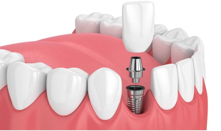 Dental implants - 3d animation on how dental implants looks