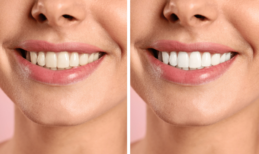How can I maximize my teeth-whitening results?
