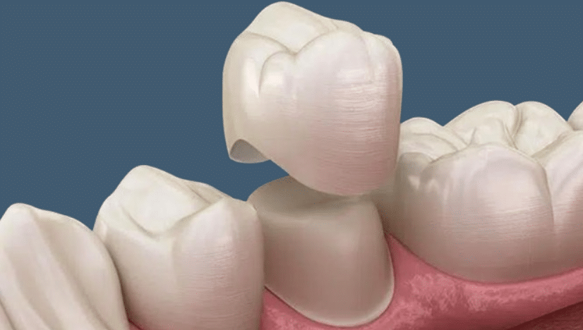 The Benefits of Using Dental Crowns for Fixing Gaps Explained