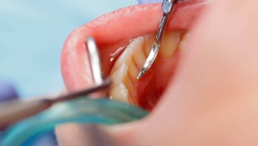 Removing Dental Cement from Porcelain Crowns Safely