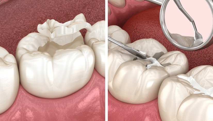 A Guide to Eat Right After Dental Sealant Treatment