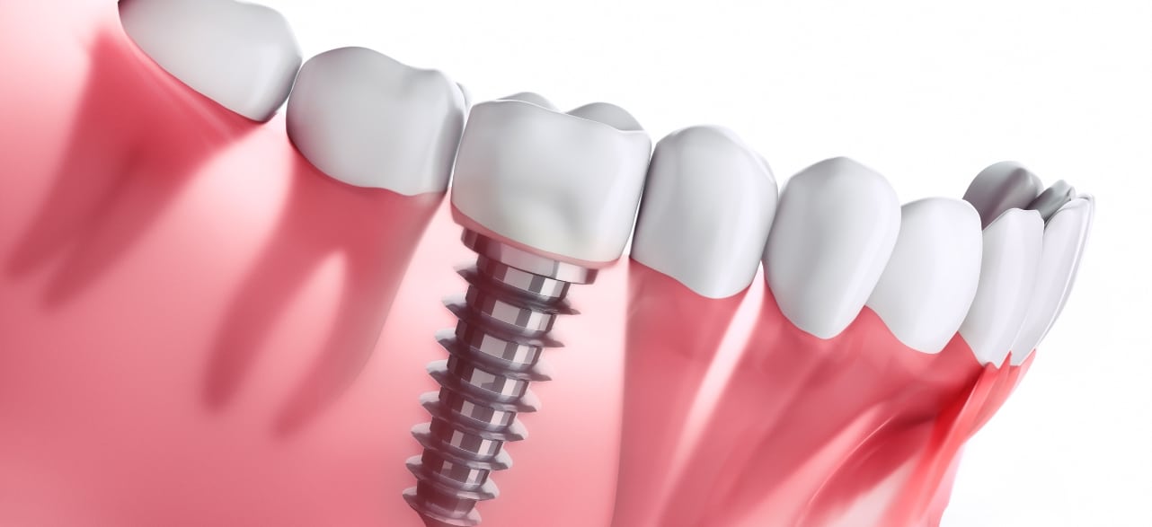 What Does a Treatment of Dental Implant Involve?