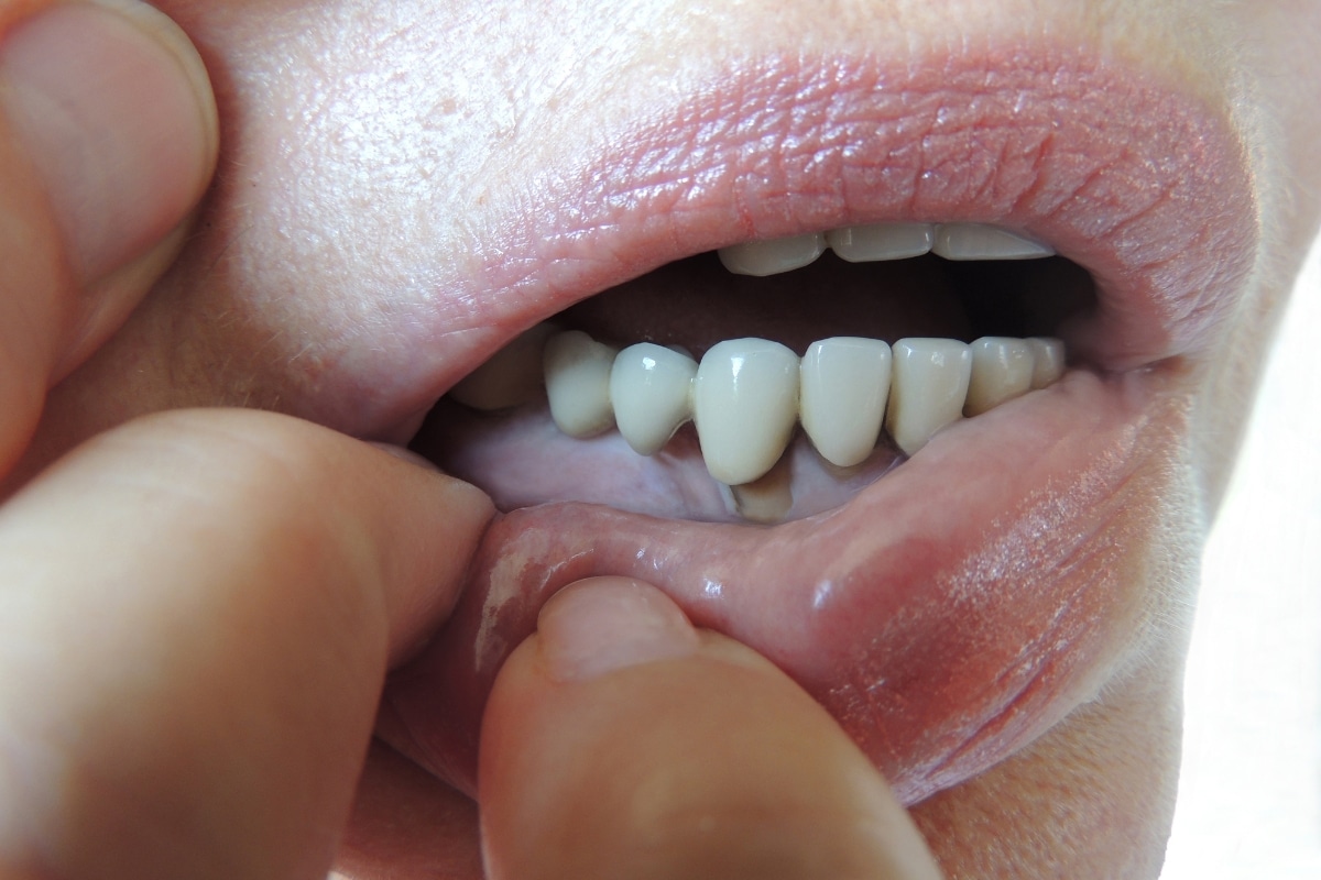 Receding Gums McKinney: What To Do Next