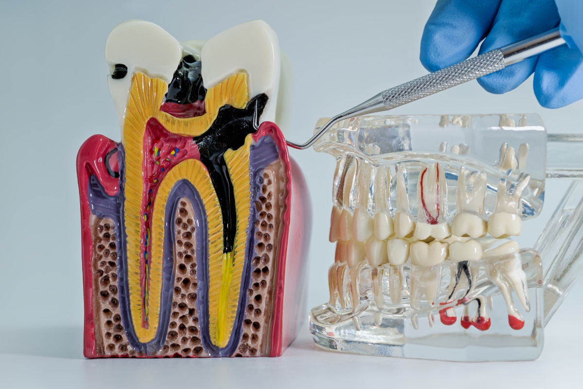 6 Ways to Recover Smoothly After a Root Canal