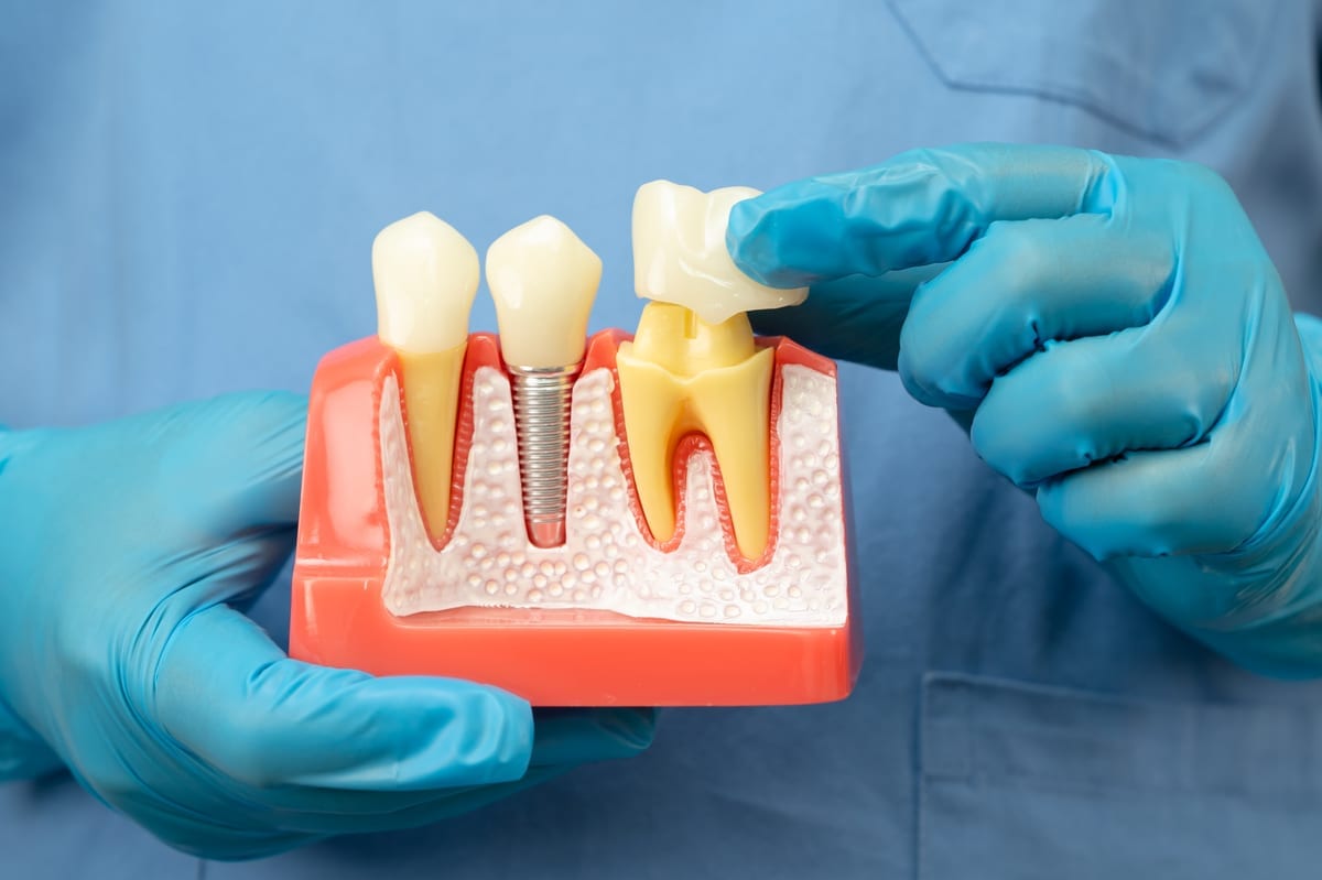 Crowns vs. Veneers: When Your Dentist Chooses Each One