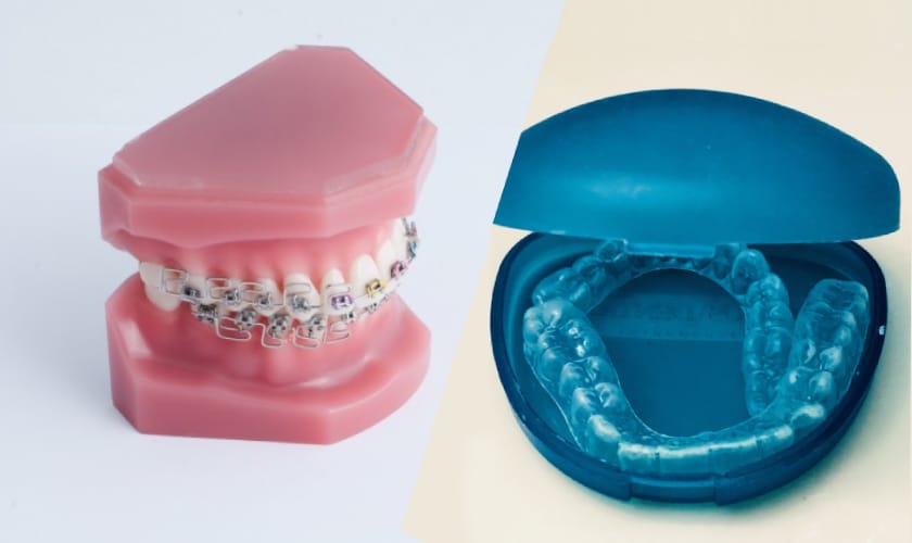 Braces and Invisalign