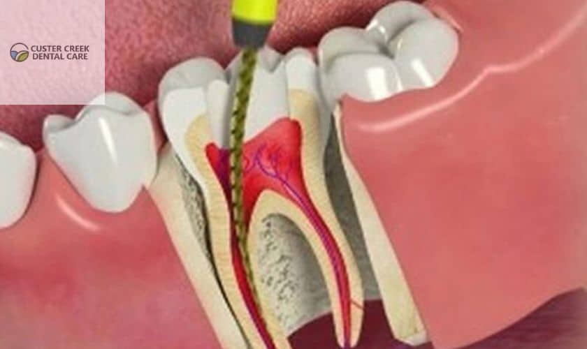 root-canal-treatment