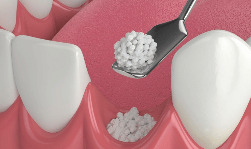 Dental Bone Grafting Procedure
