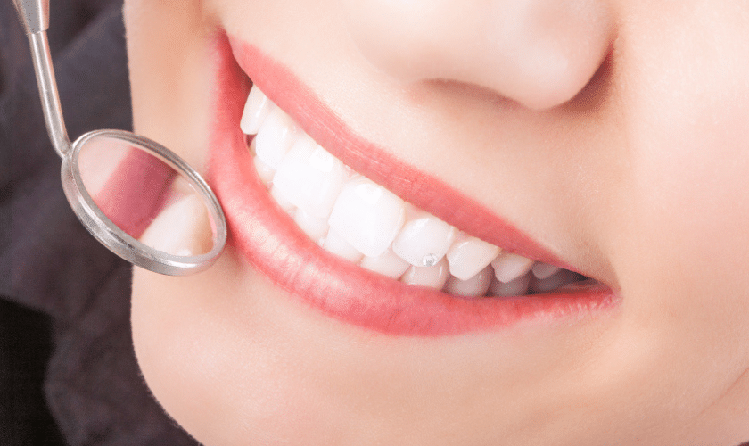 consider regarding composite fillings