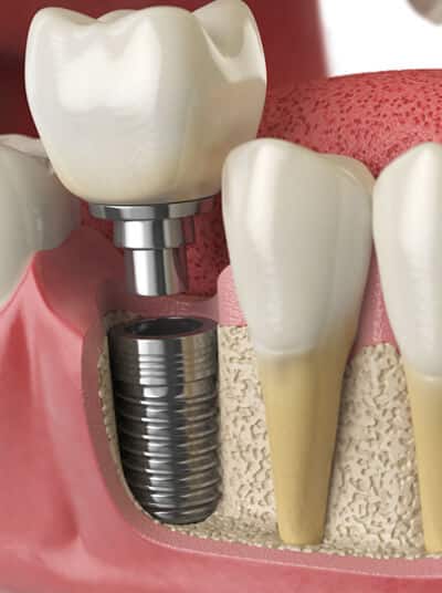 Dental implants McKinney - Custer Creek Dental Care - Dentist McKinney