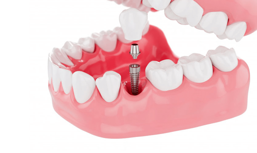 Image of Dental Implants - How Much Do Dental Implants Really Cost
