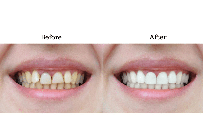 Remove Coffee Stains From Teeth
