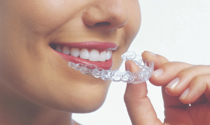 Cost Of Dental Invisalign In Mckinney A Comprehensive Guide