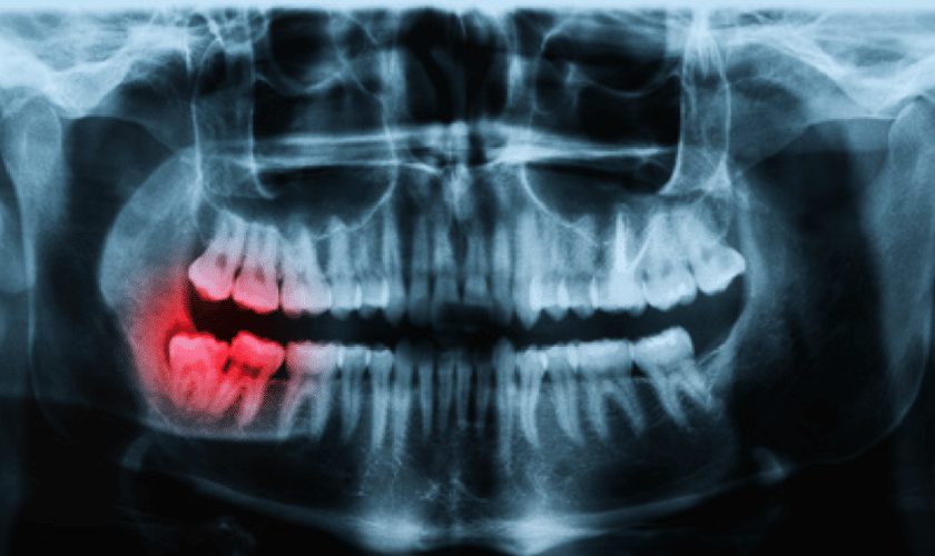 What are the three types of dental X-rays