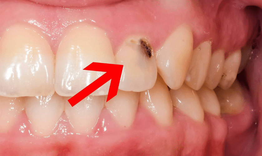 What Are Some Ways To Prevent Cavity Or Tooth Decay