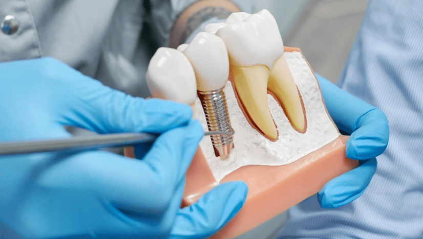 5 Myths About Dental Implants