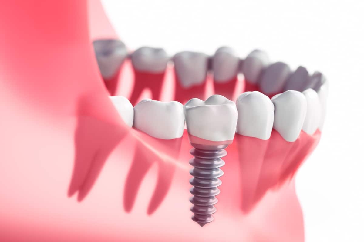 dental implants in McKinney